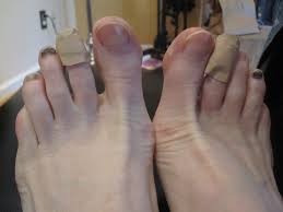 black toenails and runner s feet