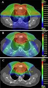 3d crt imrt and proton beam therapy