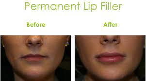 lip augmentation enhancement raleigh
