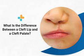 cleft lip and a cleft palate