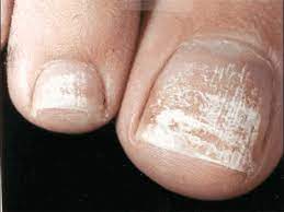 dry painful toenail or fingernails
