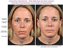 sculptra dermal filler before after