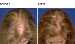 womens hair loss solutions revitalyze md knoxville
