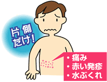 帯状疱疹について | 豊田市の皮膚科【かすがい皮膚科】