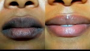 treatments prevention of dark lips