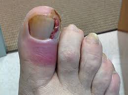 ingrown toenails advanced foot