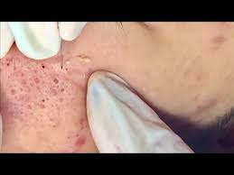 Anti acne therapy blackhead removal by dr.lalit kasana 21aug.2018. Blackhead Extraction Videos 2020