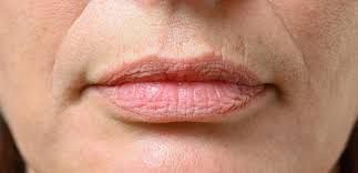 best treatment for wrinkles above lips