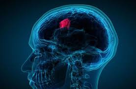 brain tumor surgery hospital in india