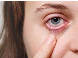 eye allergy itchy eyes symptoms causes