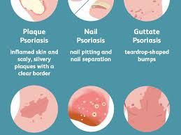 Psoriasis tends to run in families, but it may be skip generations. Psoriasis Symptoms And Complications