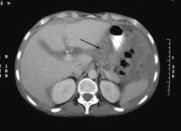 We did not find results for: Abdominal Computed Tomography Scans In The Selection Of Patients With Malignant Peritoneal Mesothelioma For Comprehensive Treatment With Cytoreductive Surgery And Perioperative Intraperitoneal Chemotherapy Yan 2005 Cancer Wiley Online Library