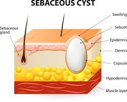sebaceous cysts what is a sebaceous