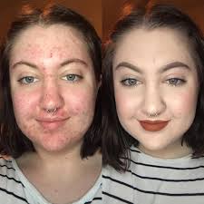 how to cover acne with makeup