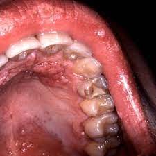 saliva test detects hidden throat cancer