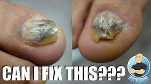 damaged deformed big toenail