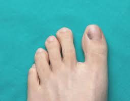 bruised toenail the chelsea clinic