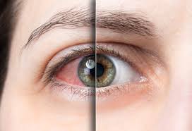 eye allergies during allergy season