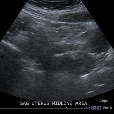 Transabdominally (through the abdomen) and transvaginally (through the vaginal canal). Transvaginal Ultrasound Cedars Sinai