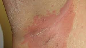 Guttate psoriasis guttate psoriasis is most common psoriasis during puberty. Inverse Psoriasis Causes Symptoms And When To See A Doctor