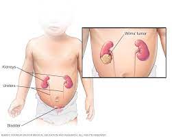 Stomach cancer symptoms often do not appear in the early stages and may be mistaken for less serious problems when they do. Wilms Tumor Symptoms And Causes Mayo Clinic