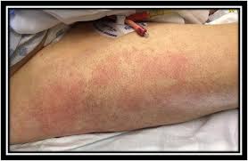 specifical blanching erythematous rash