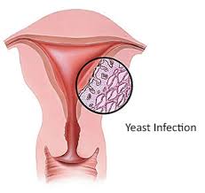 home remes for yeast infection