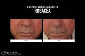 what triggers rosacea and how is it