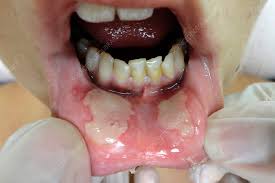 canker sores stock image c040 2295