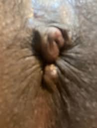 Anal sex with skin tag