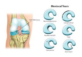radial meniscus tears all you need to
