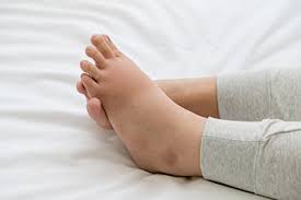 reduce swollen feet during pregnancy