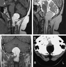 a posterior fossa lipoma extending into