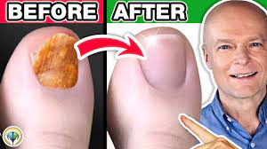 1 absolute best toenail fungus cure