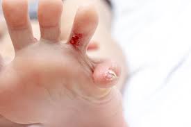 7 types of foot rashes how to treat