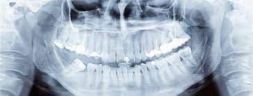 dental cone beam ct scan over an x ray