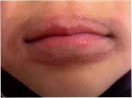 lip lickers dermais causes