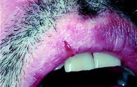 staphylococcal fissure of the upper lip