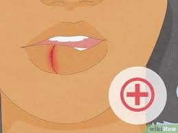 how to treat a cut lip fast first aid