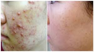 acne scars i best indian home remes