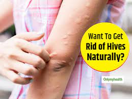irritated with hives try these