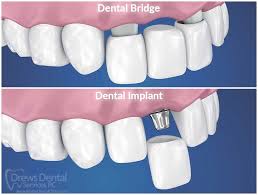dental bridges vs implants drews