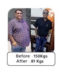 bariatric surgery before after