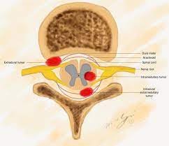 benign spinal cord tumors