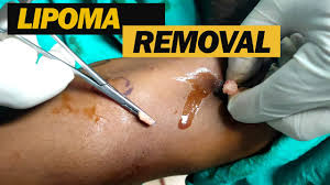 49 lipoma removal by dr prashant yadav