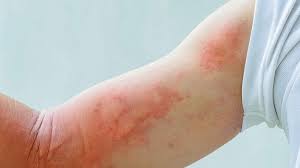7 natural remes for skin rash
