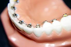 Check spelling or type a new query. Fiksni Aparatic Za Zube Vidljive I Nevidljive Bravice Visodent Dentalna Medicina