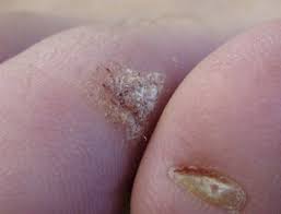 warts onset symptoms and treatment