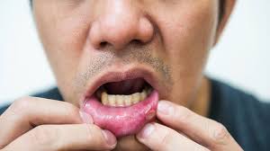 9 faqs about canker sores everyday health