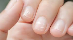 white spots on your fingernails